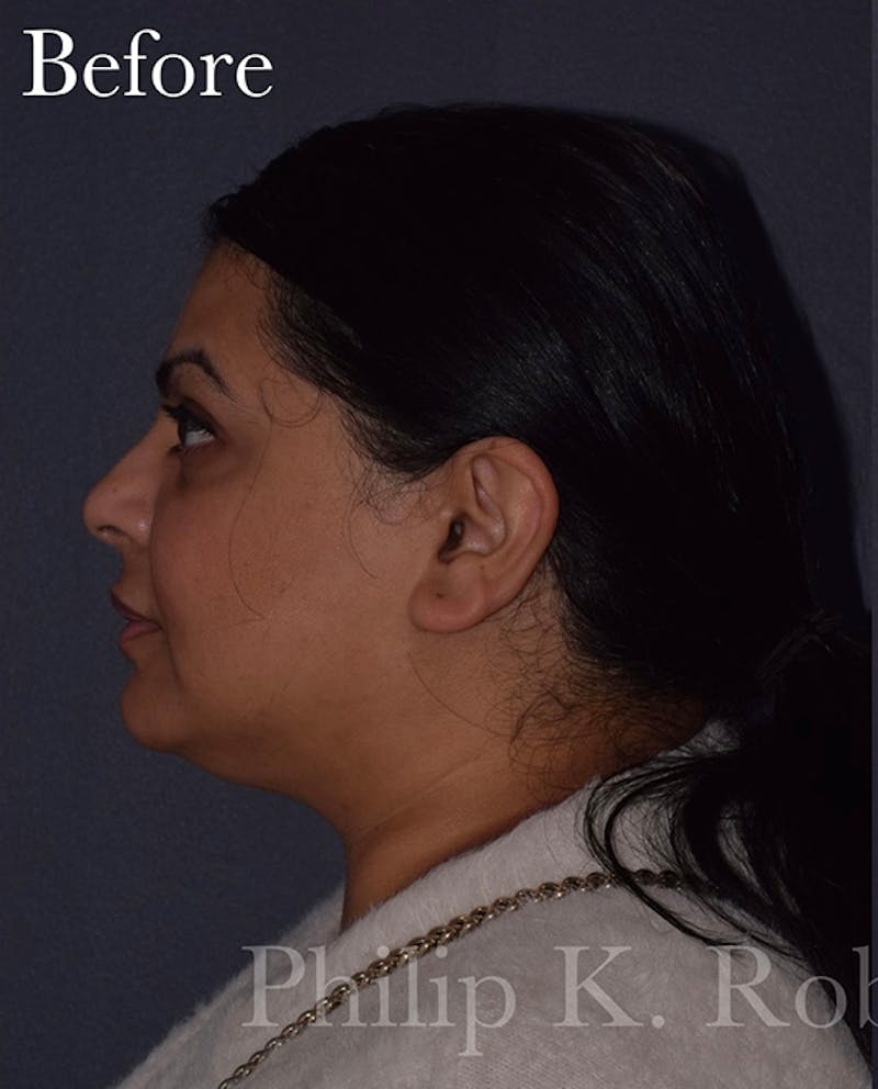 Buccal Fat Reduction Before & After Gallery - Patient 261506 - Image 5