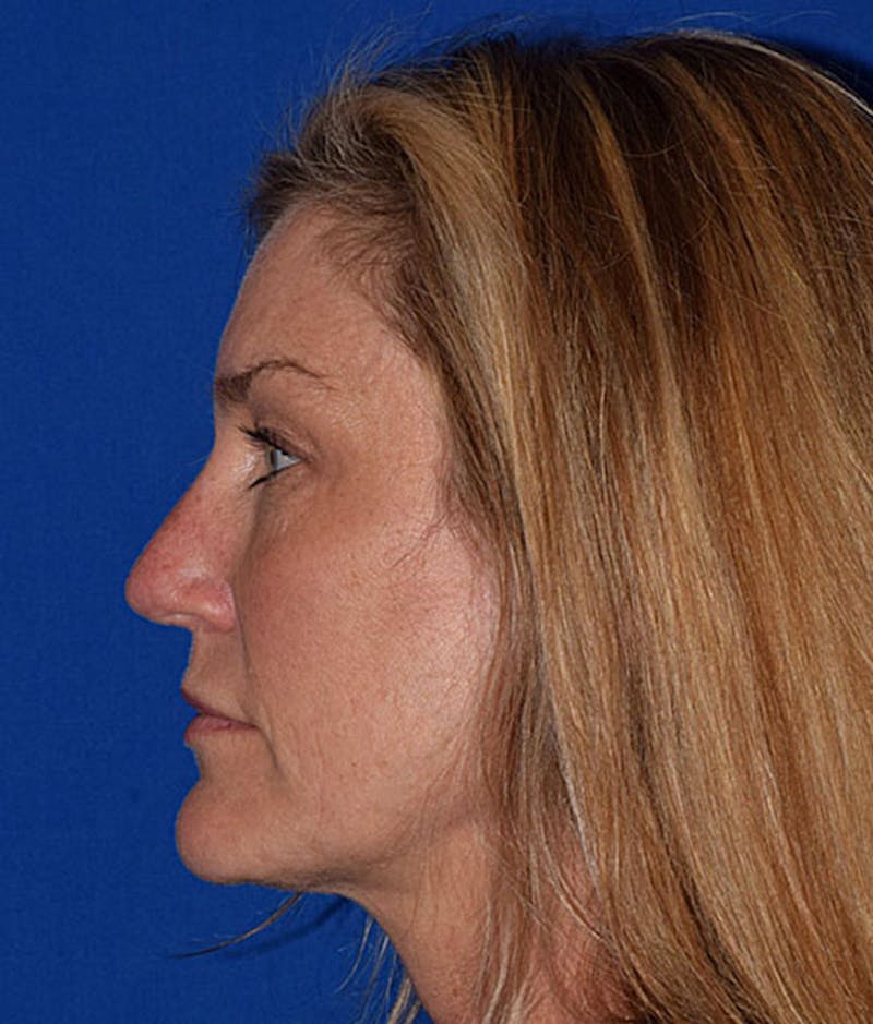 Lip Lift Before & After Gallery - Patient 135841 - Image 5