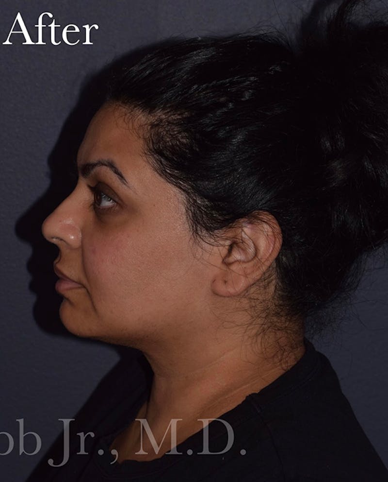 Buccal Fat Reduction Before & After Gallery - Patient 261506 - Image 6