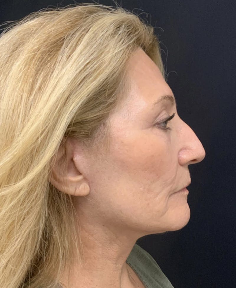 Facelift Before & After Gallery - Patient 162113 - Image 10