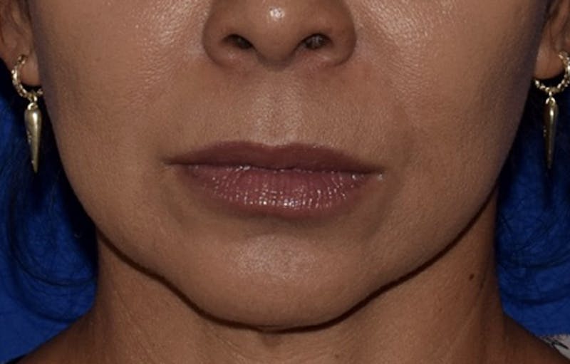 Lip Lift Before & After Gallery - Patient 402447 - Image 1