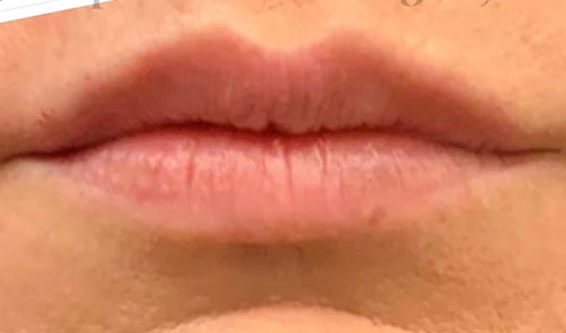 Fillers Before & After Gallery - Patient 124378 - Image 2
