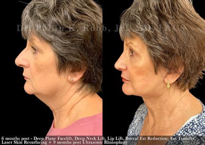 Neck Lift Before & After Gallery - Patient 381987 - Image 1