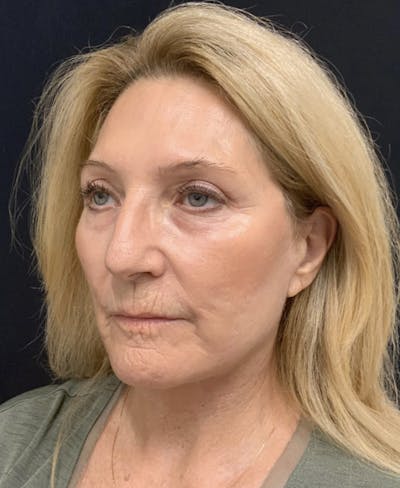 Facelift Before & After Gallery - Patient 162113 - Image 2