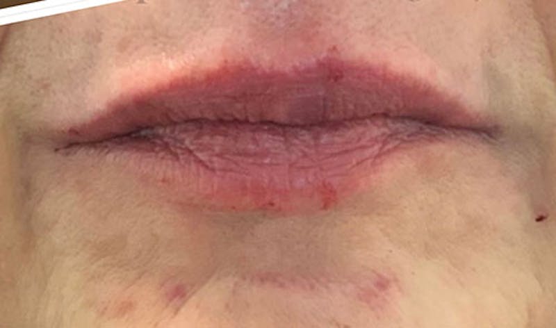 Fillers Before & After Gallery - Patient 744286 - Image 2