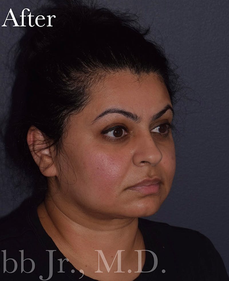 Buccal Fat Reduction Before & After Gallery - Patient 261506 - Image 10