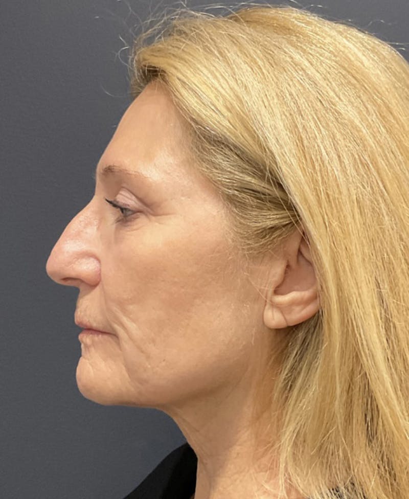 Facelift Before & After Gallery - Patient 162113 - Image 3