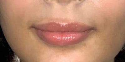 Fillers Before & After Gallery - Patient 399090 - Image 1