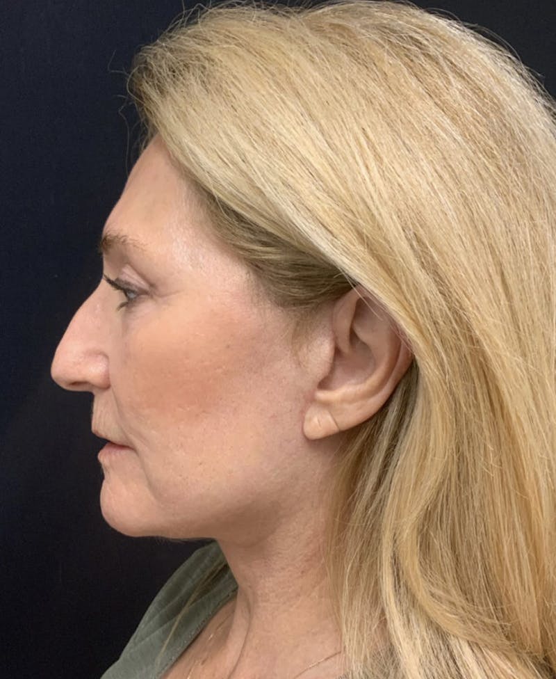 Facelift Before & After Gallery - Patient 162113 - Image 4