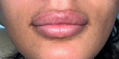 Fillers Before & After Gallery - Patient 399090 - Image 2