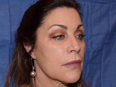 Fillers Before & After Gallery - Patient 329722 - Image 1