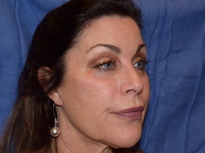 Fillers Before & After Gallery - Patient 329722 - Image 2