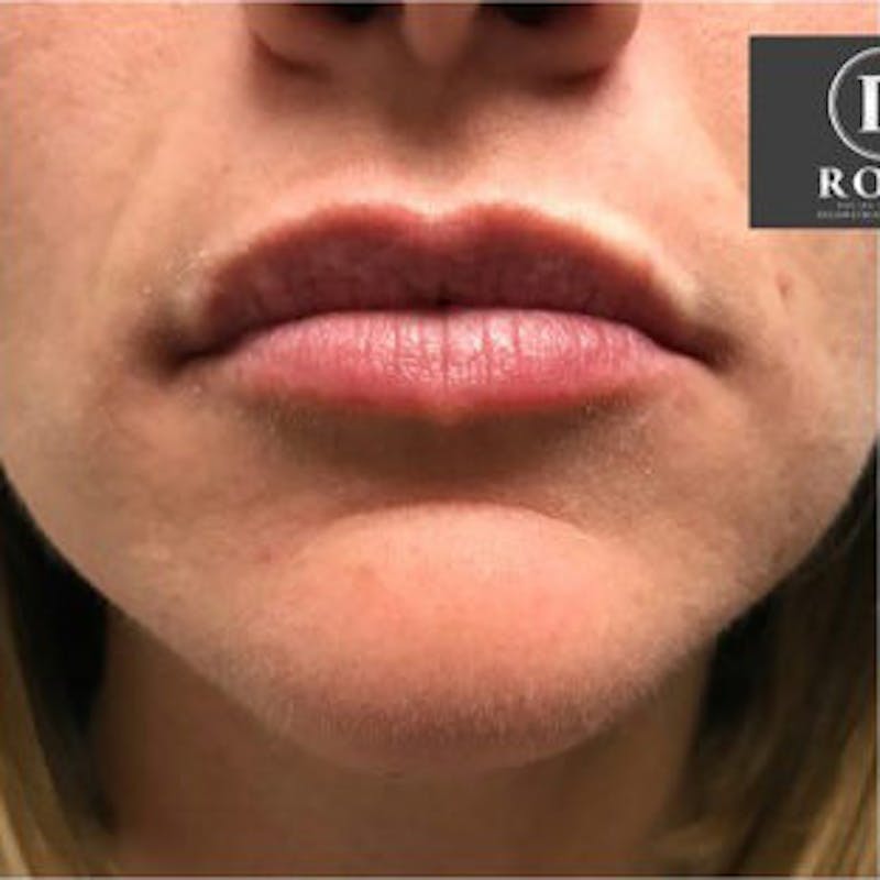 Fillers Before & After Gallery - Patient 967855 - Image 1