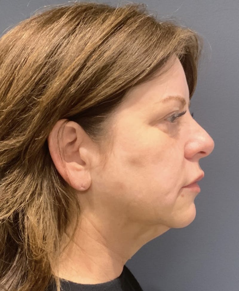 Facelift Before & After Gallery - Patient 170231 - Image 9