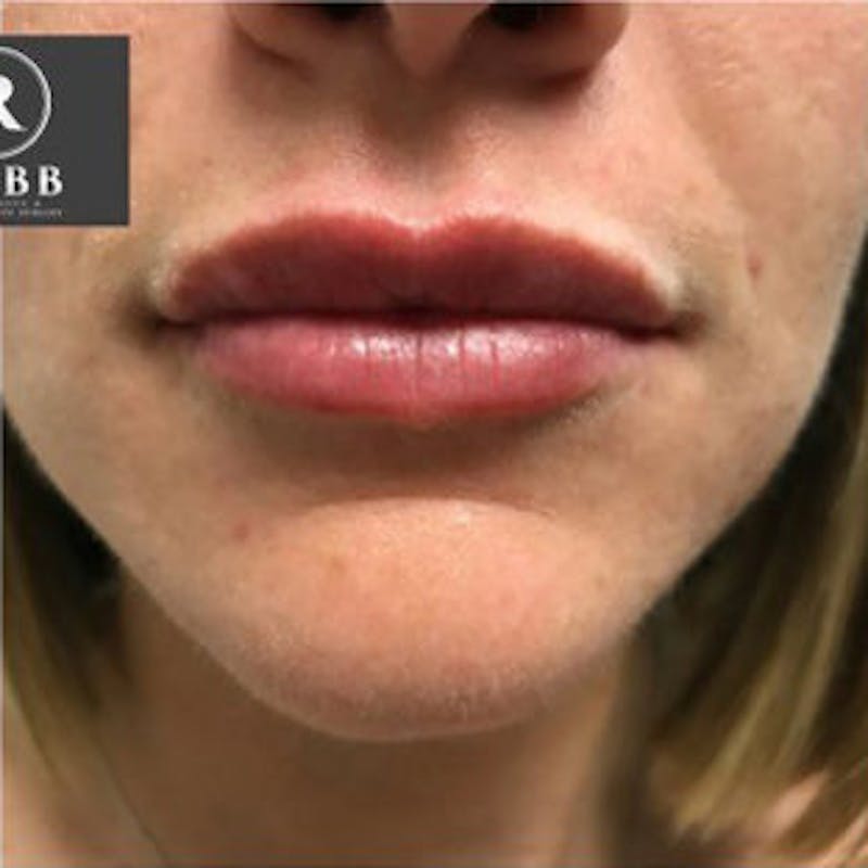 Fillers Before & After Gallery - Patient 967855 - Image 2