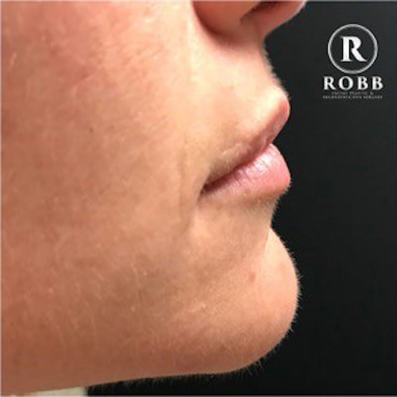 Fillers Before & After Gallery - Patient 967855 - Image 3