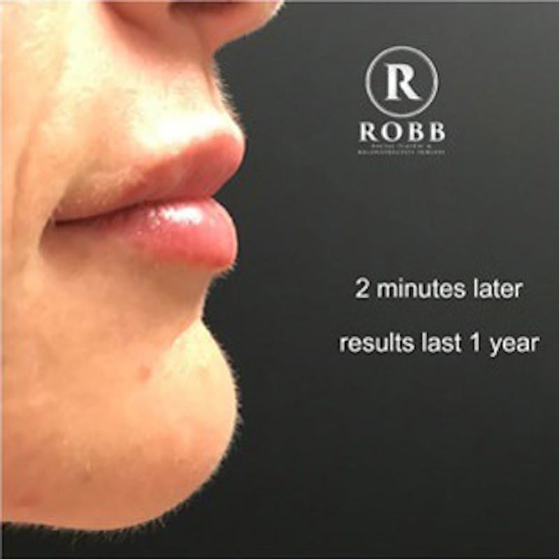 Fillers Before & After Gallery - Patient 967855 - Image 4