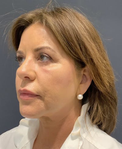 Facelift Before & After Gallery - Patient 170231 - Image 2