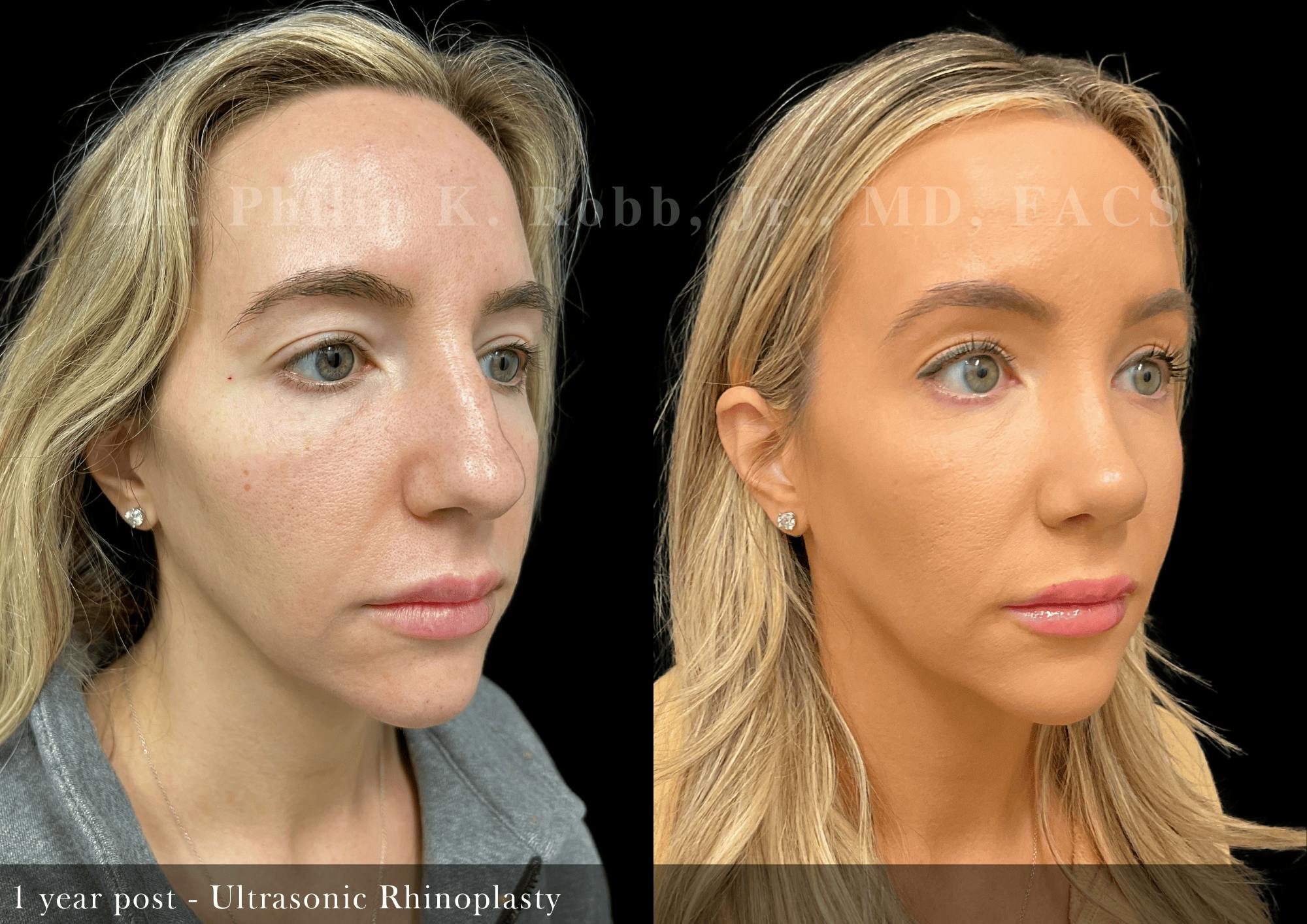Ultrasonic Rhinoplasty Before & After Gallery - Patient 257824 - Image 2