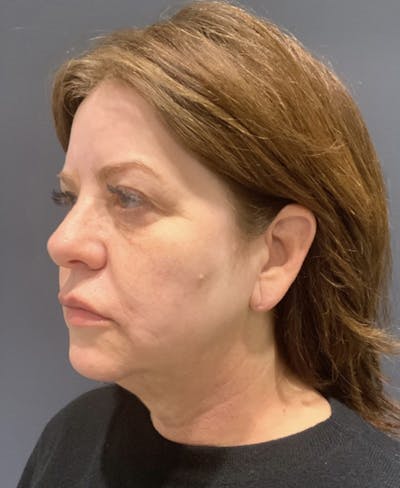 Facelift Before & After Gallery - Patient 170231 - Image 1
