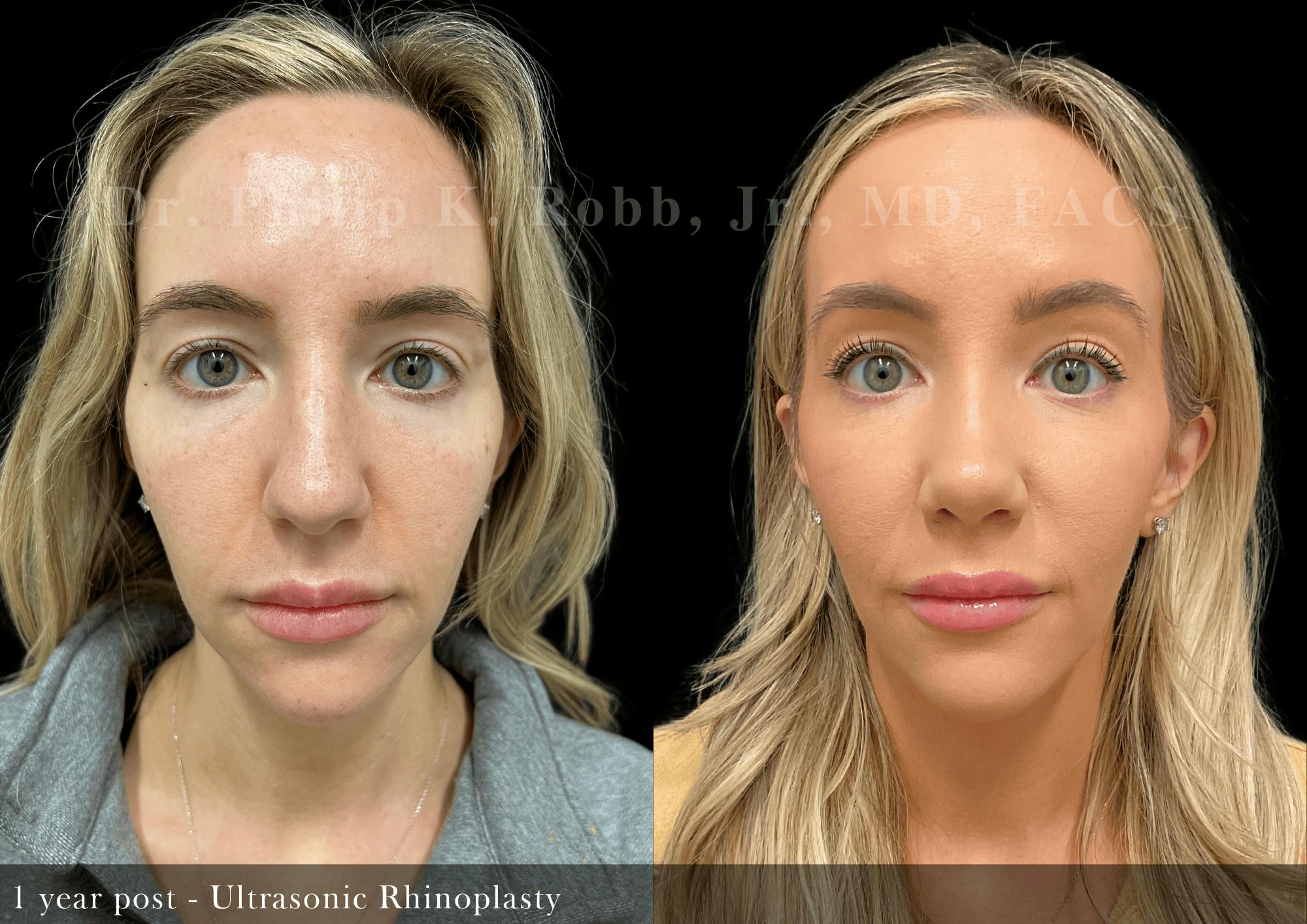 Ultrasonic Rhinoplasty Before & After Gallery - Patient 257824 - Image 3