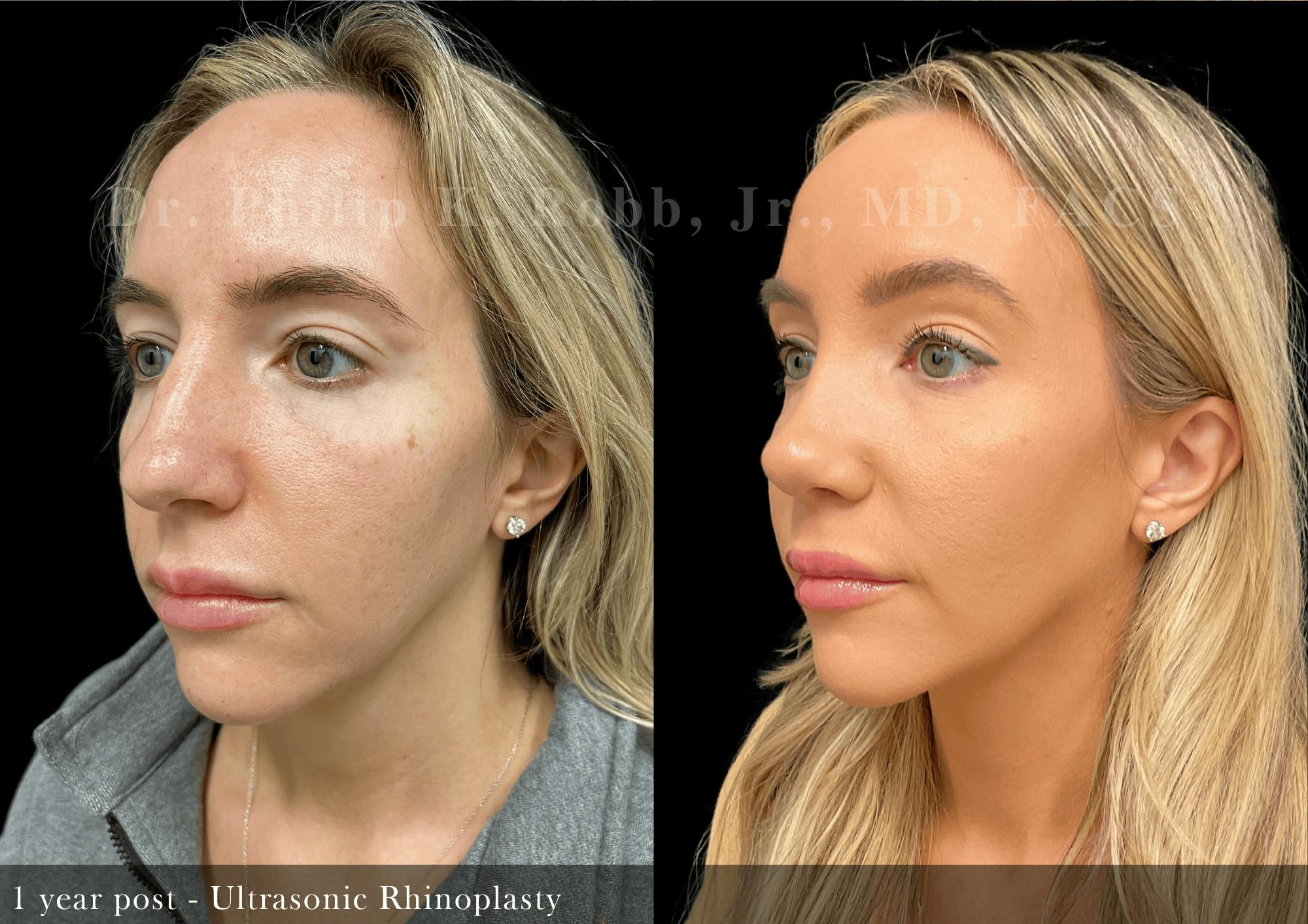 Ultrasonic Rhinoplasty Before & After Gallery - Patient 257824 - Image 4