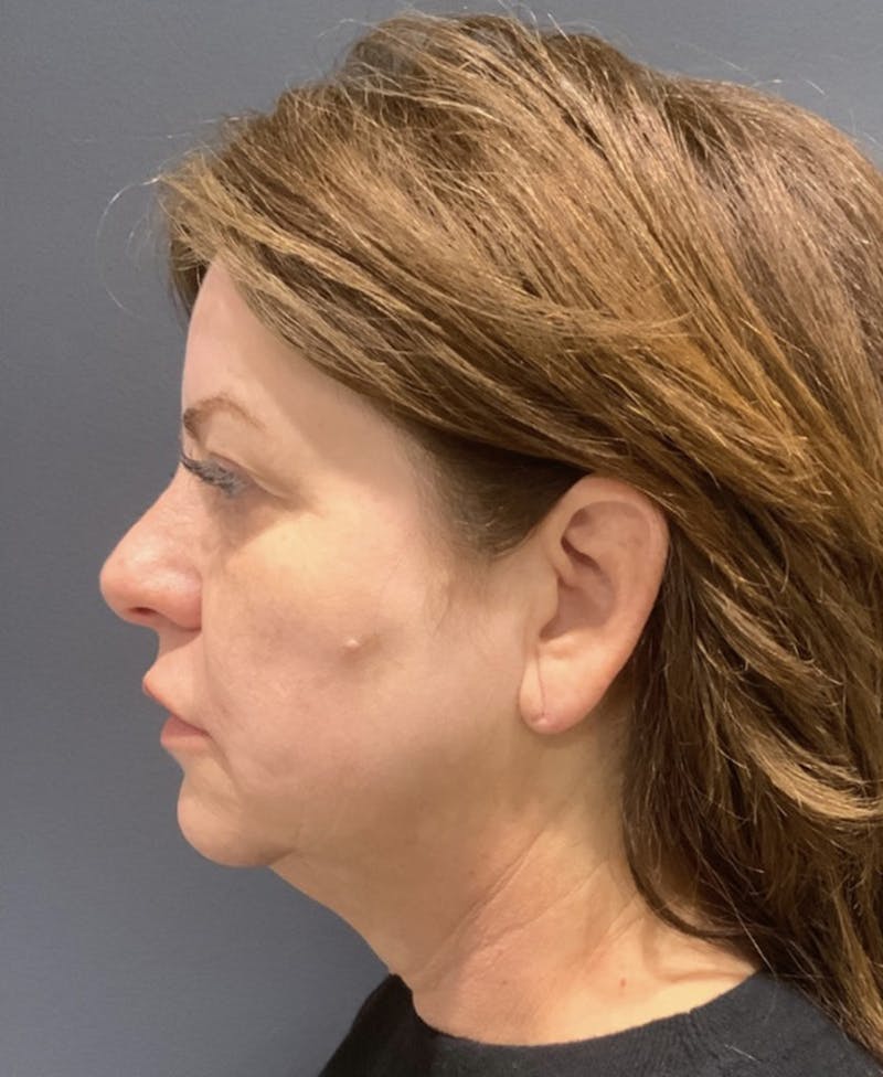 Facelift Before & After Gallery - Patient 170231 - Image 3