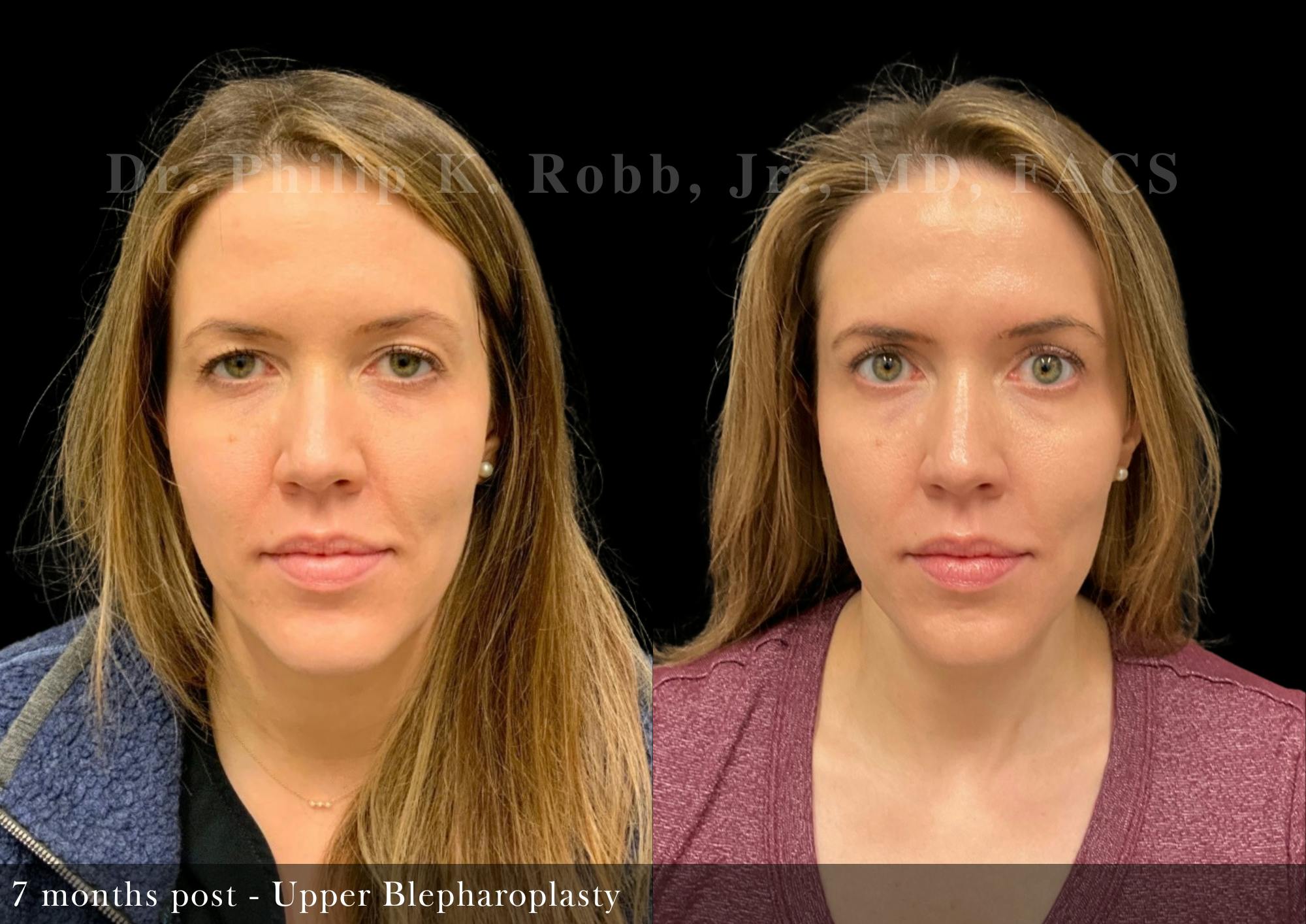 Upper Blepharoplasty Before & After Gallery - Patient 347808 - Image 1
