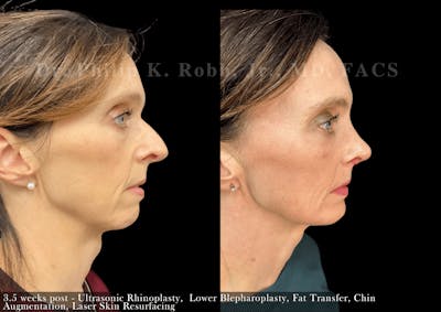 Ultrasonic Rhinoplasty Before & After Gallery - Patient 589754 - Image 1