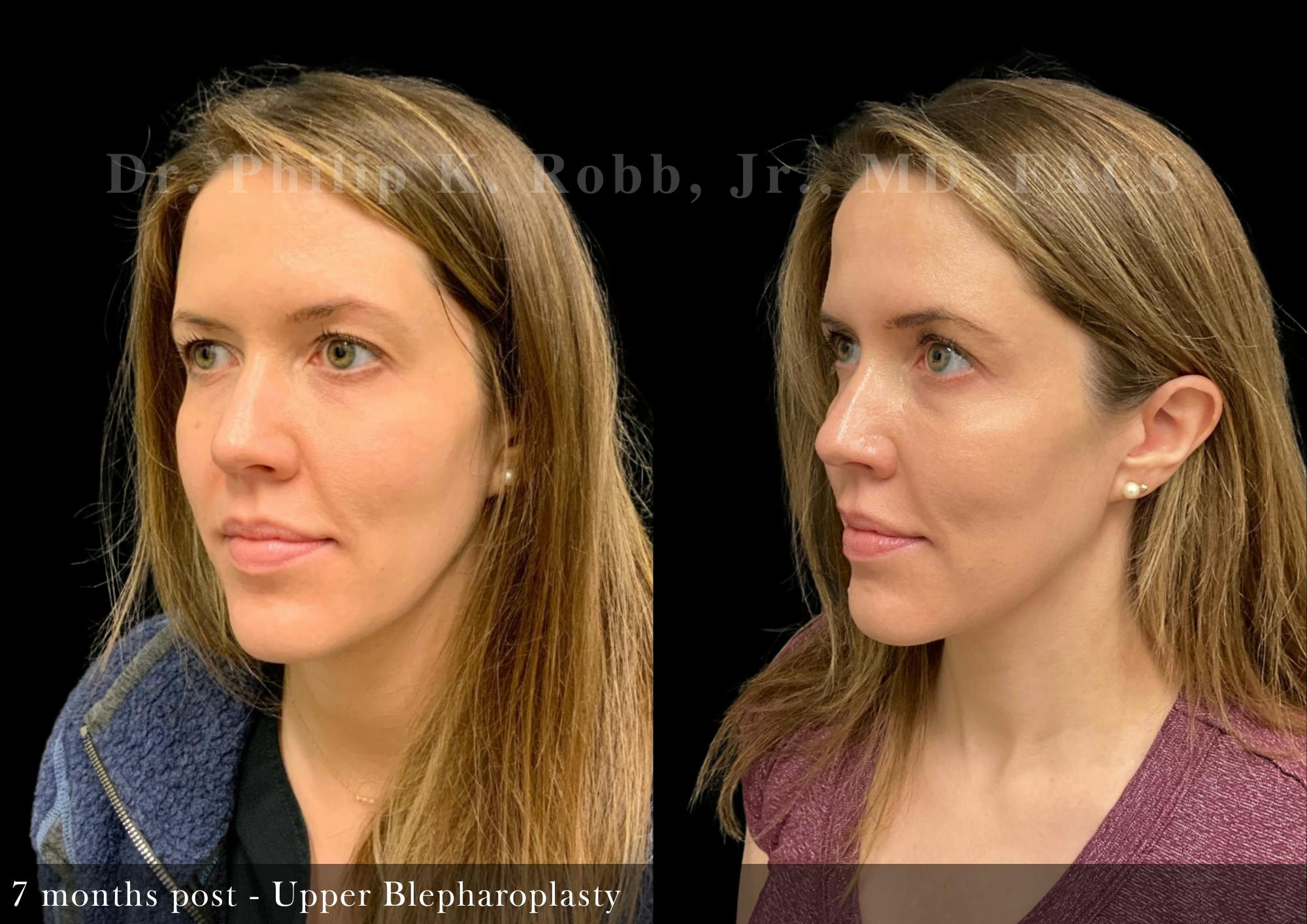 Upper Blepharoplasty Before & After Gallery - Patient 347808 - Image 2