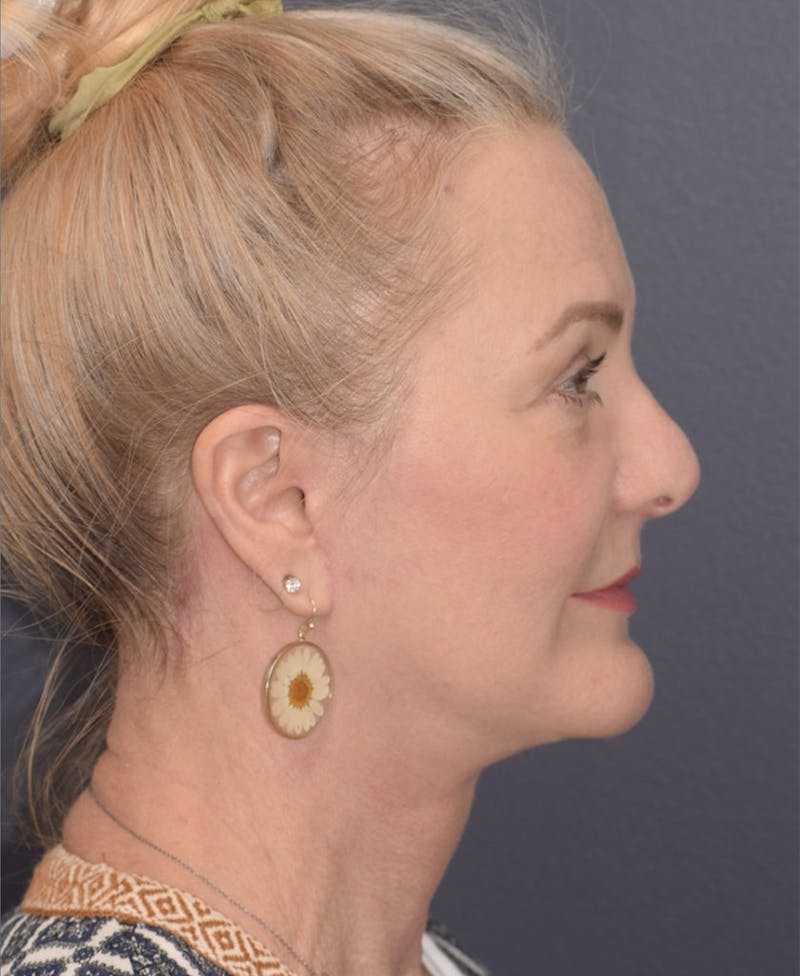 Facelift Before & After Gallery - Patient 397348 - Image 10