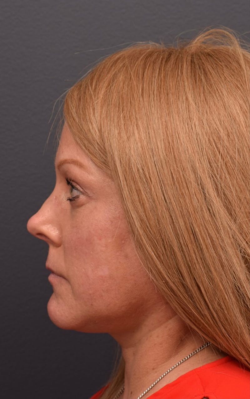 Buccal Fat Reduction Before & After Gallery - Patient 217504 - Image 9