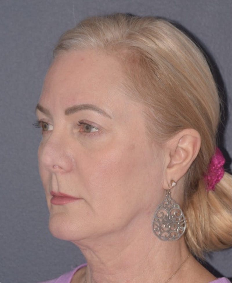 Facelift Before & After Gallery - Patient 397348 - Image 1