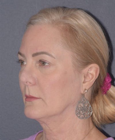 Facelift Before & After Gallery - Patient 397348 - Image 1