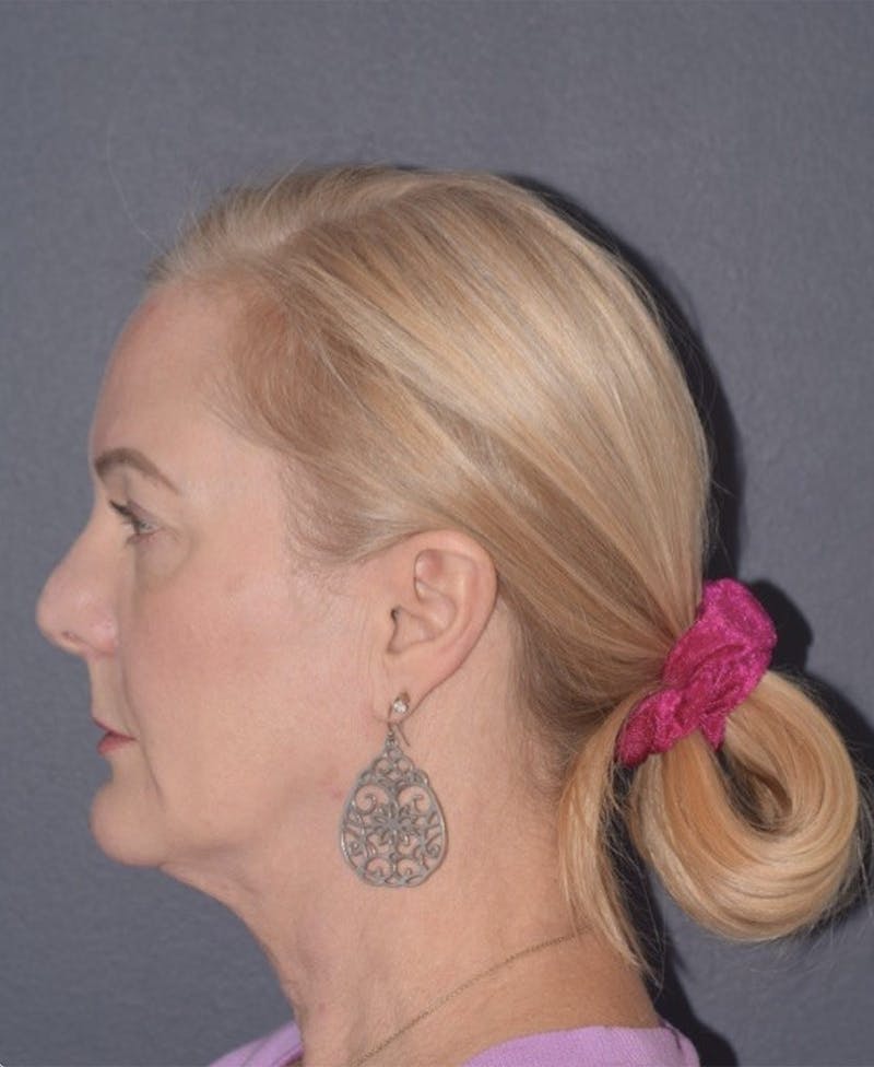 Facelift Before & After Gallery - Patient 397348 - Image 3