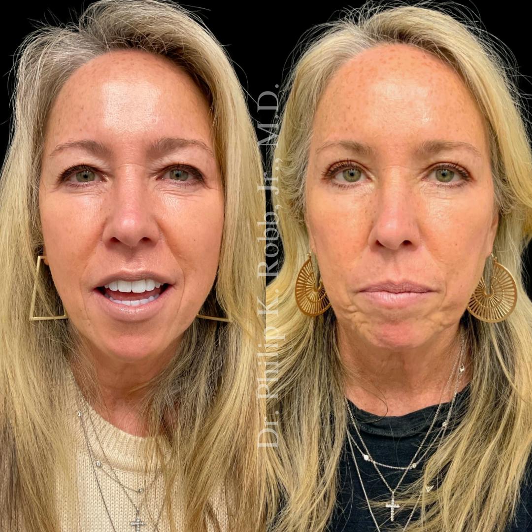 Upper Blepharoplasty Before & After Gallery - Patient 399425 - Image 2