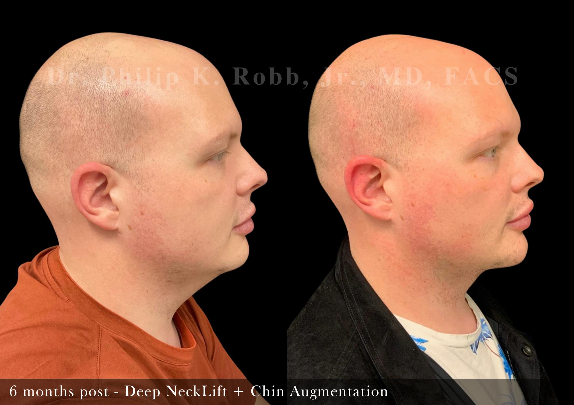 Neck Lift Before & After Gallery - Patient 382966 - Image 2