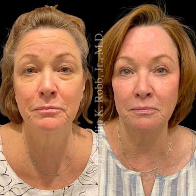 Upper Blepharoplasty Before & After Gallery - Patient 169677 - Image 1