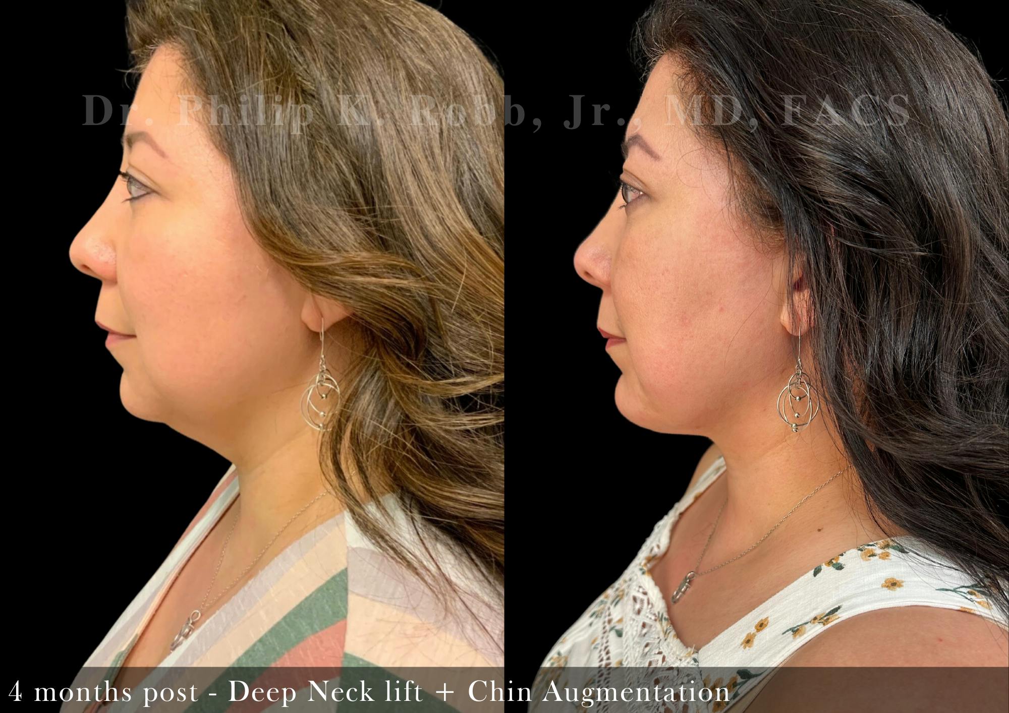 Neck Lift Before & After Gallery - Patient 909696 - Image 1