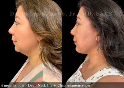 Neck Lift Before & After Gallery - Patient 909696 - Image 1