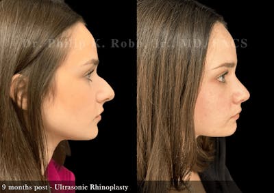 Ultrasonic Rhinoplasty Before & After Gallery - Patient 406874 - Image 1