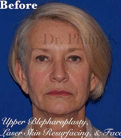 Facelift Before & After Gallery - Patient 200236 - Image 1