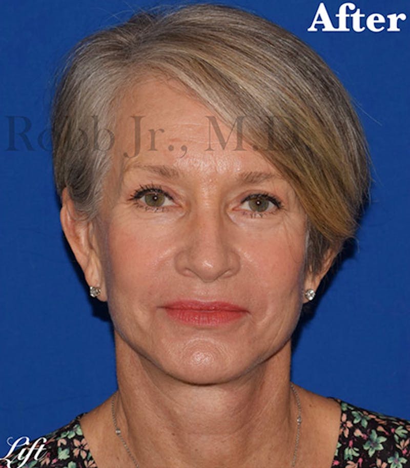 Facelift Before & After Gallery - Patient 200236 - Image 2