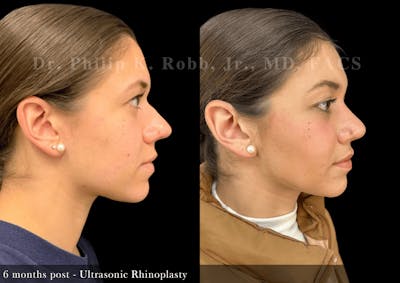 Ultrasonic Rhinoplasty Before & After Gallery - Patient 414625 - Image 1