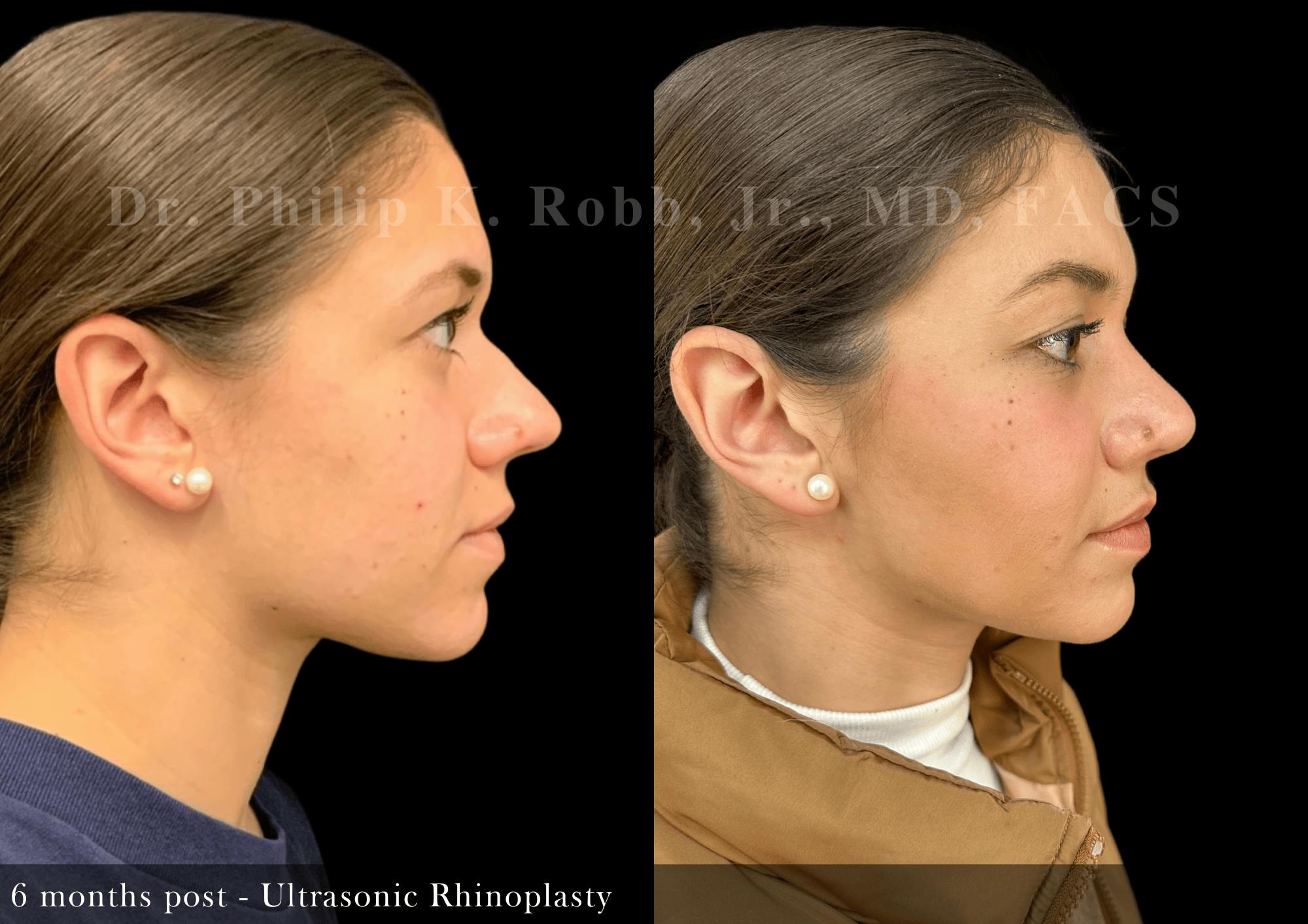 Ultrasonic Rhinoplasty Before & After Gallery - Patient 414625 - Image 1