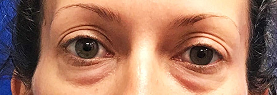 Lower Blepharoplasty Before & After Gallery - Patient 318980 - Image 1