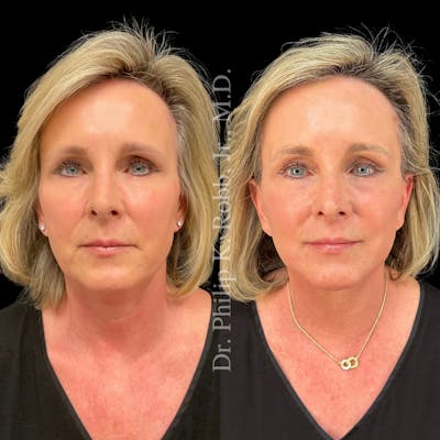 Upper Blepharoplasty Before & After Gallery - Patient 307713 - Image 1