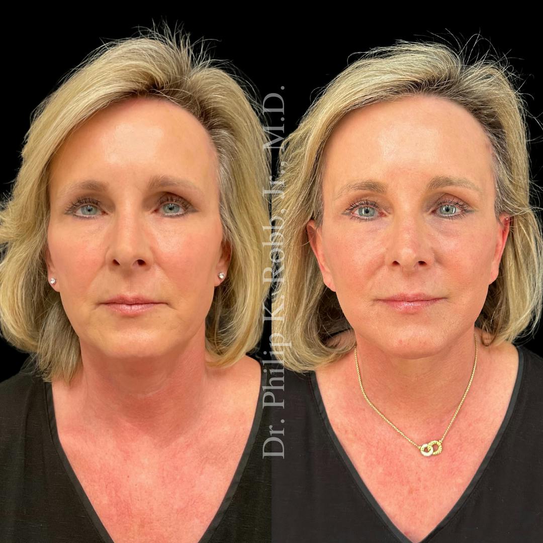 Upper Blepharoplasty Before & After Gallery - Patient 307713 - Image 1