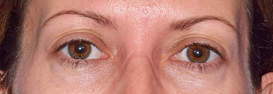 Lower Blepharoplasty Before & After Gallery - Patient 318980 - Image 2
