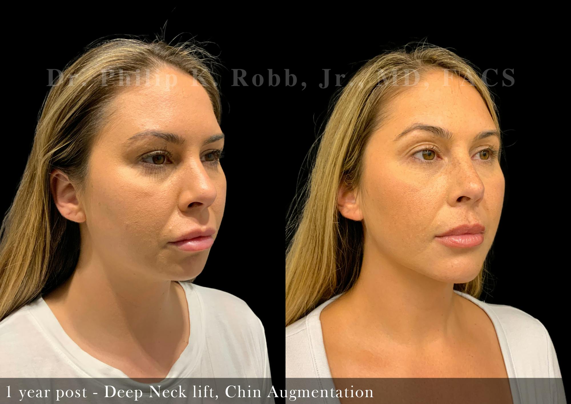 Neck Lift Before & After Gallery - Patient 426813 - Image 4